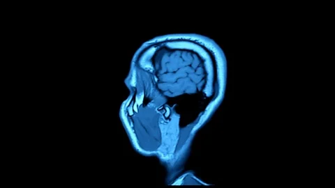 MRI scan. Human brain. 스톡 동영상 124680509