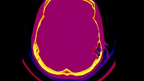 MRI Scan of the Human Brain Highlighting Neural Structure and Activity with Stock Footage 318506347