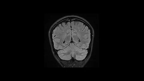 Mri Scan. Human Brain. RMN Scan. Stock Footage 124703111