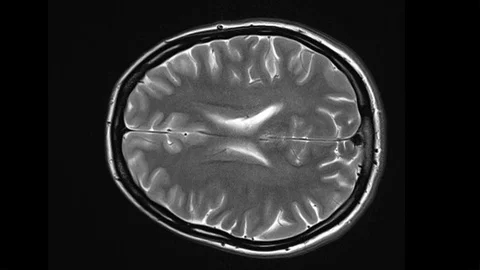 Mri Scan. Human Brain. RMN Scan. 스톡 동영상 124703156