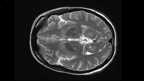 Mri Scan. Human Brain. RMN Scan. Stock Footage 124703157
