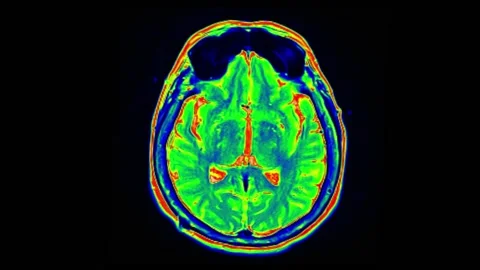 Mri Scan. Human Brain. RMN Scan. Stock Footage 134964234
