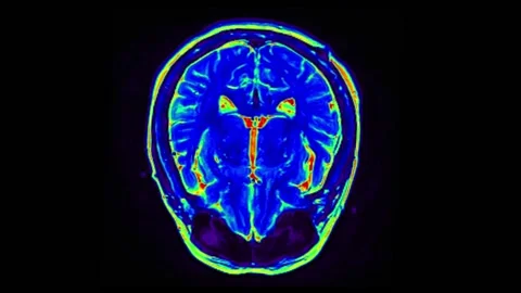 Mri Scan. Human Brain. RMN Scan. Stock Footage 134964285