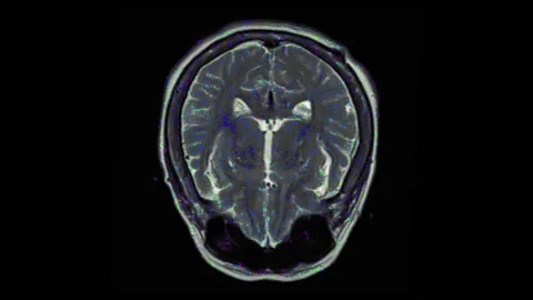 Mri Scan. Human Brain. RMN Scan. Stock Footage 134964423