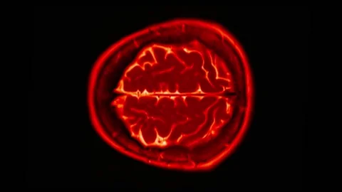 Mri Scan. Human Brain. RMN Scan. Stock Footage 134964734