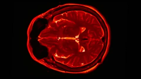Mri Scan. Human Brain. RMN Scan. Stock Footage 134964754