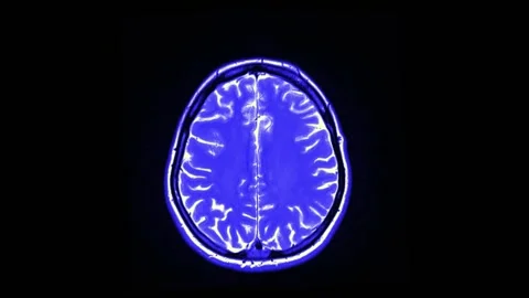 Mri Scan. Human Brain. RMN Scan. Stock Footage 135607291