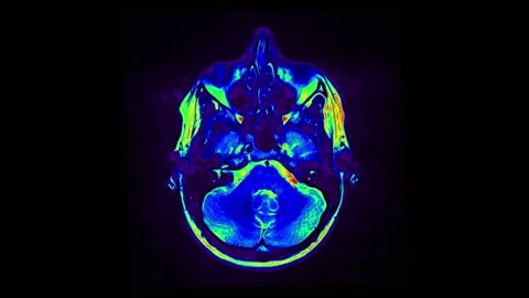 Mri Scan. Human Brain. RMN Scan. Stockbeeldmateriaal 135607296