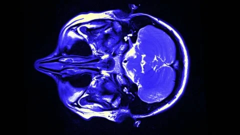 Mri Scan. Human Brain. RMN Scan. Stock Footage 135752684