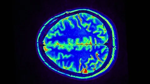 Mri Scan. Human Brain. RMN Scan. 스톡 동영상 135752695