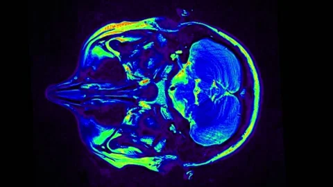 Mri Scan. Human Brain. RMN Scan. Stock Footage 135752699