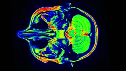 Mri Scan. Human Brain. RMN Scan. Stock Footage 135752702