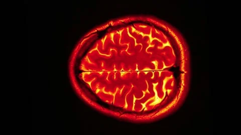 Mri Scan. Human Brain. RMN Scan. Stock Footage 135752738