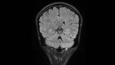 Mri Scan. Human Brain. RMN Scan. Stock Footage 136041546