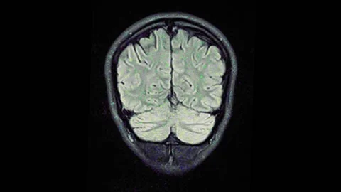 Mri Scan. Human Brain. RMN Scan. Vídeo Stock 136041580