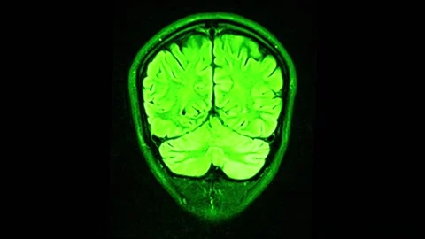 Mri Scan. Human Brain. RMN Scan. Stock Footage 136041607