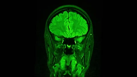 Mri Scan. Human Brain. RMN Scan. Vídeo Stock 136041609