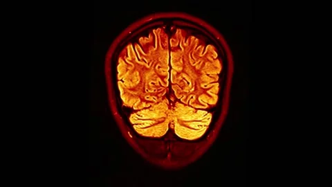 Mri Scan. Human Brain. RMN Scan. Stock Footage 136041627