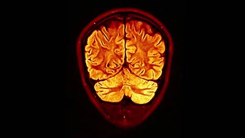 Mri Scan. Human Brain. RMN Scan. Vídeo Stock 136041630