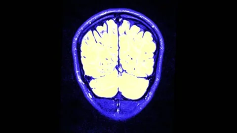 Mri Scan. Human Brain. RMN Scan. Stock Footage 136041636