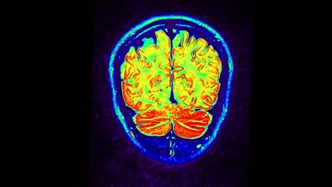 Mri Scan. Human Brain. RMN Scan. Stock Footage 136041674