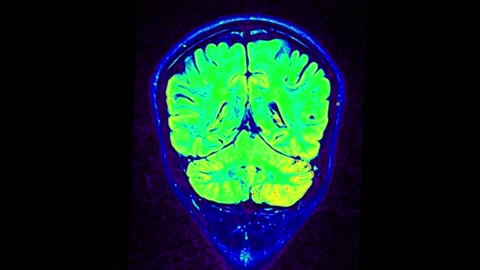 Mri Scan. Human Brain. RMN Scan. Stock Footage 136041679
