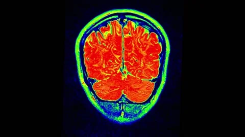 Mri Scan. Human Brain. RMN Scan. Stock Footage 136041684