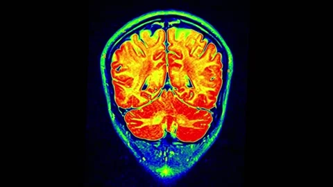 Mri Scan. Human Brain. RMN Scan. Stock Footage 136041730