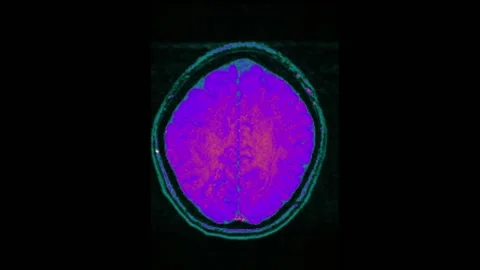 Mri Scan. Human Brain. RMN Scan. 스톡 동영상 137257078