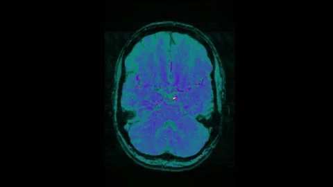 Mri Scan. Human Brain. RMN Scan. 스톡 동영상 137257110