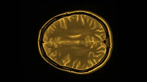 Mri Scan. Human Brain. RMN Scan. Stock Footage 151411302