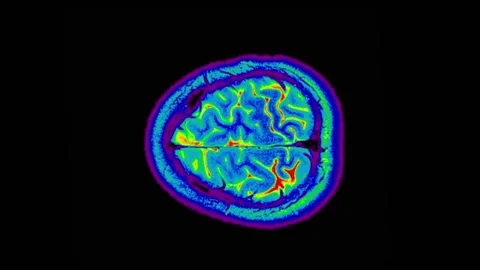 Mri Scan. Human Brain. RMN Scan. Stock Footage