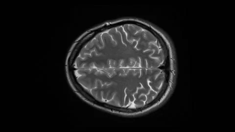 Mri Scan. Human Brain. RMN Scan. Stock Footage 151411449