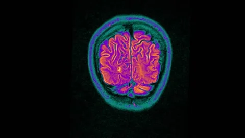 Mri Scan. Human Brain Scan. | Stock Video | Pond5