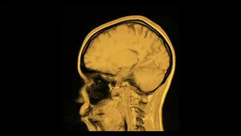 Mri Scan. Human Brain Scan. Vídeo Stock 136117396