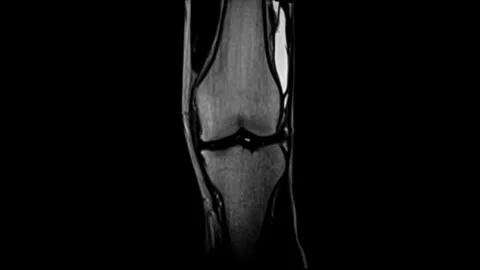 MRI Scan of a Human Knee Joint Stock Footage 341776976