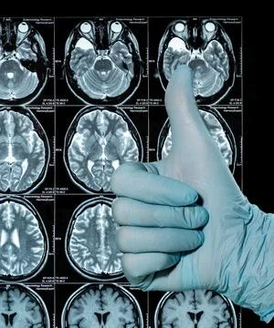MRI Scan image of a human brain showing all main multiple sclerosis hand in b Stock Photos