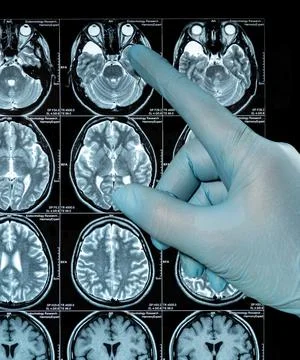 MRI Scan image of a human brain showing all main multiple sclerosis hand in b Stock Photos