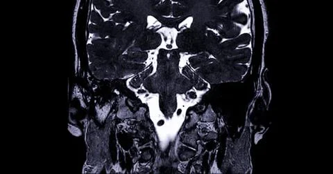 MRI  scan  of  the internal auditory canal (IAC) . Stock Photos