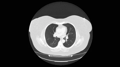 MRI scan of the lungs and bronchi, diagnosis of respiratory diseases Stock Footage 113740607