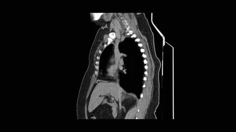 MRI scan of the lungs and bronchi, diagnosis of respiratory diseases Video stock 113740658