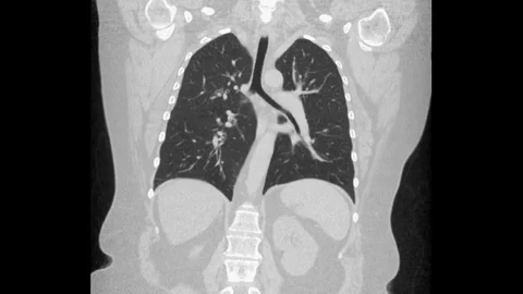 MRI scan of the lungs and bronchi, diagnosis of respiratory diseases Stock Footage 115480968