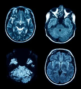Mri scan Stock-Fotos