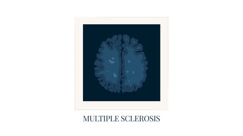 MRI scan photo frame of brain affected by multiple sclerosis, animation Stock Footage 120142655