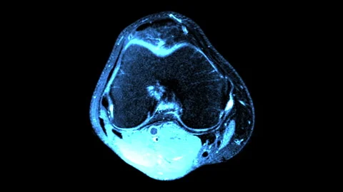 MRI Scan of Right Knee Joint - Ligament Injury and Sports Trauma Diagnosis Video stock 311065032
