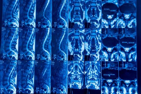 MRI scan of spine a patient with chronic back pain. Stock Photos