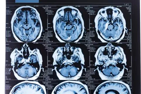 14,028 Mri Scan Brain Images, Stock Photos, 3D objects, & Vectors |  Shutterstock