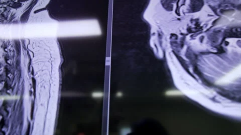 MRI scans of the patient. Stock Footage 314111462
