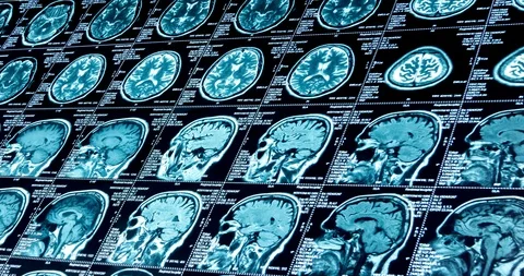 MRI scans of various sizes are moving diagonally, looped Stock Footage 106321987