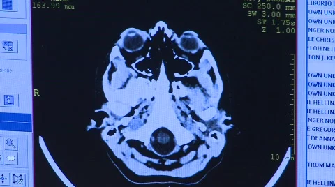 MRI screen - brain scan Stock Footage 693760